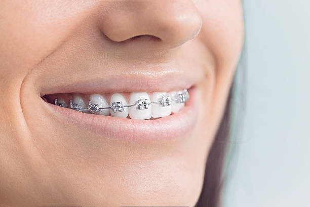 Dental Bonding in Spring City, PA